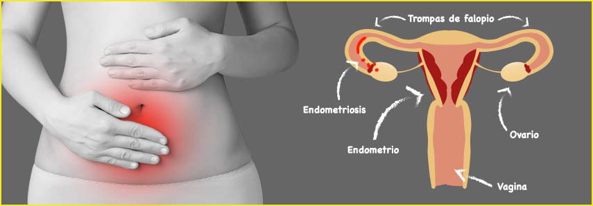 (c) Endometriosisweb.com